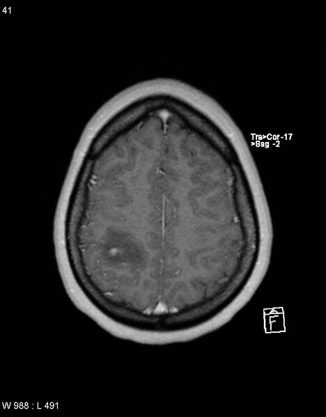 File:Astroblastoma (Radiopaedia 39792-42217 Axial T1 C+ 40).jpg