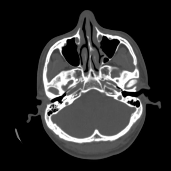 File:Asymptomatic occipital spur (Radiopaedia 87753-104201 Axial bone window 29).jpg