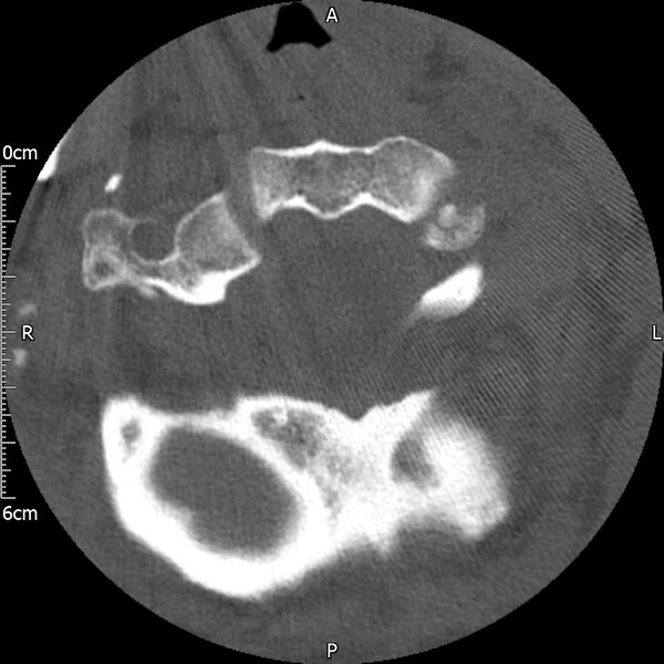 File:Atlas fracture with Currarino type A congenital defect (Radiopaedia 71747-82144 Axial bone window 42).jpg