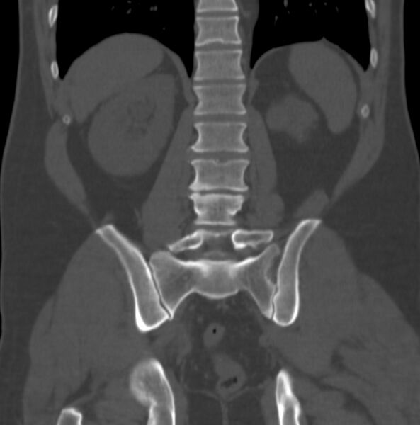 File:Atrophic kidney due to severe chronic obstructive hydronephrosis (Radiopaedia 40828-43474 Coronal bone window 9).jpg