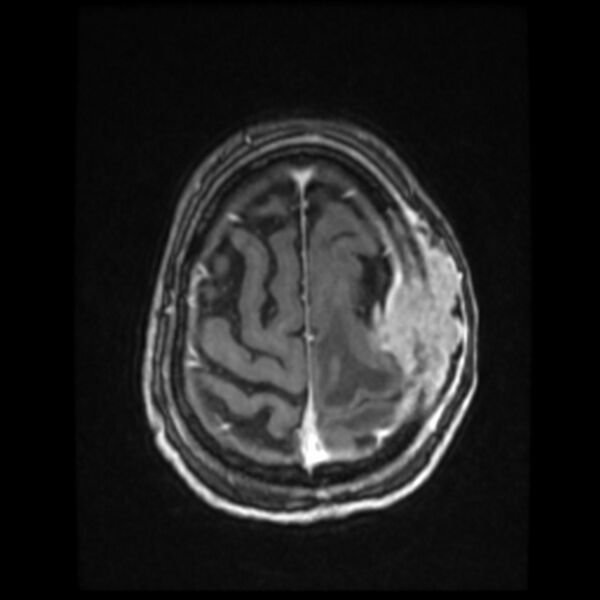 File:Atypical meningioma (Radiopaedia 45535-49629 Axial T1 C+ 57).jpg