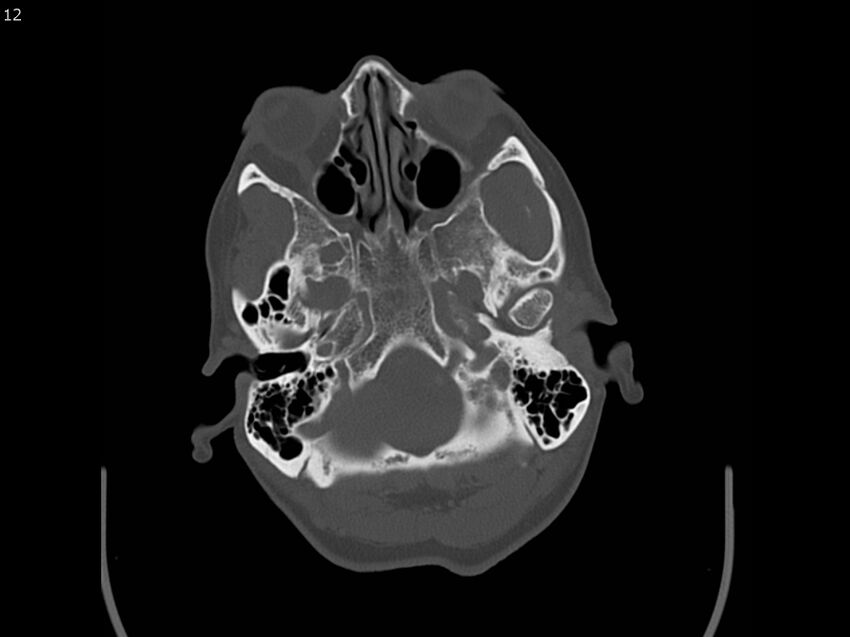 Atypical meningioma - intraosseous (Radiopaedia 64915-73867 Axial C+ bone window 12).jpg