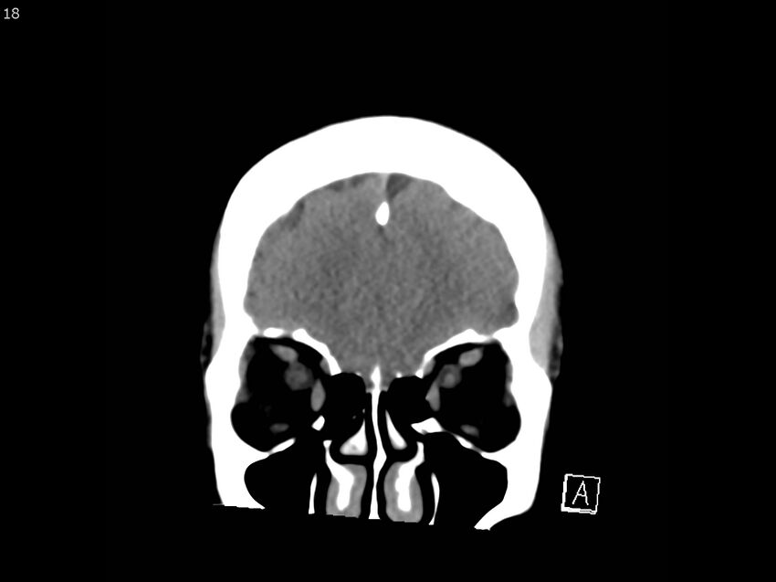 Atypical meningioma - intraosseous (Radiopaedia 64915-73867 B 17).jpg