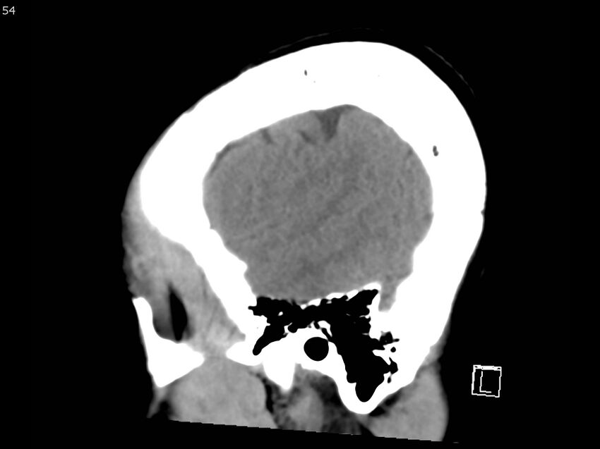 Atypical meningioma - intraosseous (Radiopaedia 64915-73867 C 52).jpg
