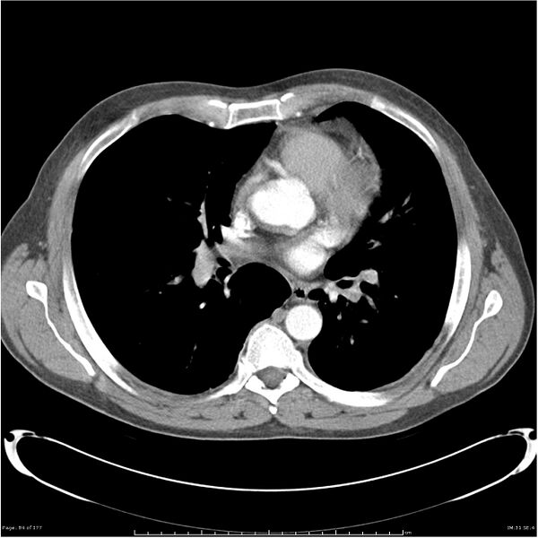 File:Atypical pneumonia - Q fever (Radiopaedia 21993-21989 C+ arterial phase 26).jpg