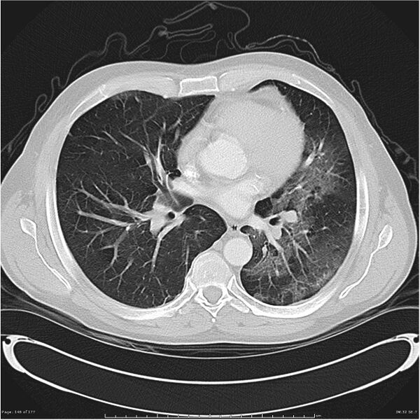 File:Atypical pneumonia - Q fever (Radiopaedia 21993-21989 lung window 25).jpg