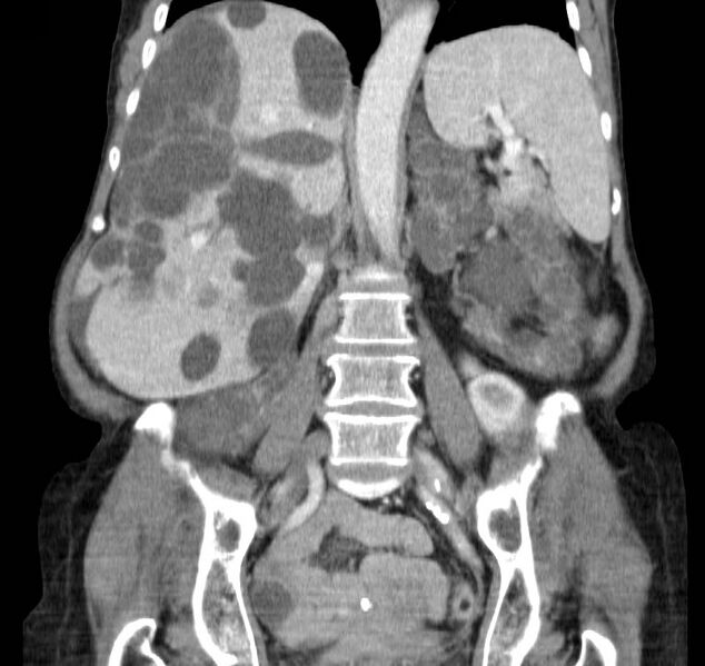 File:Autosomal dominant polycystic kidney disease (Radiopaedia 16777-16490 B 29).jpg