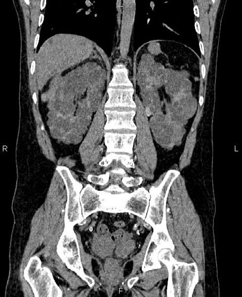 File:Autosomal dominant polycystic kidney disease (Radiopaedia 87830-104287 Coronal non-contrast 43).jpg