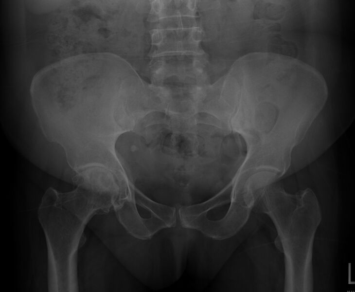File:Avascular necrosis with secondary osteoarthritis (Radiopaedia 12291-12584 Frontal 1).jpg