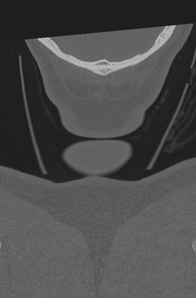 File:Axis peg fracture (type 3) and atlas lateral mass (type 4) fracture (Radiopaedia 37474-39324 Coronal bone window 76).png