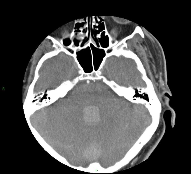 File:Basal ganglia hemorrhage (Radiopaedia 58763-65985 D 55).jpg