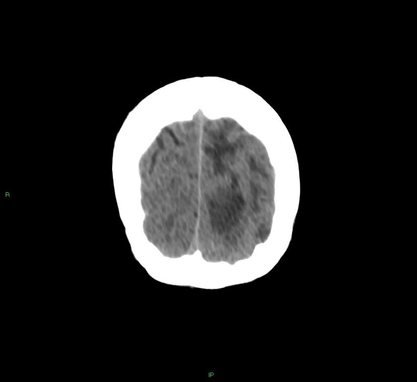 Basal ganglia hemorrhage (Radiopaedia 58766-65988 Coronal non-contrast 11).jpg