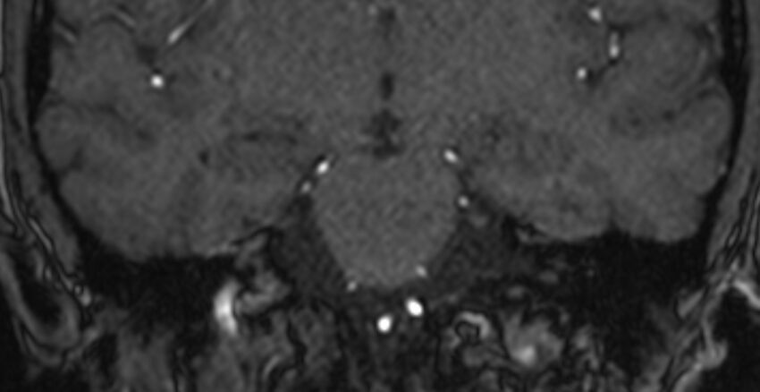 Basilar artery fenestration (Radiopaedia 74537-85455 Coronal MRA TOF 55).jpg