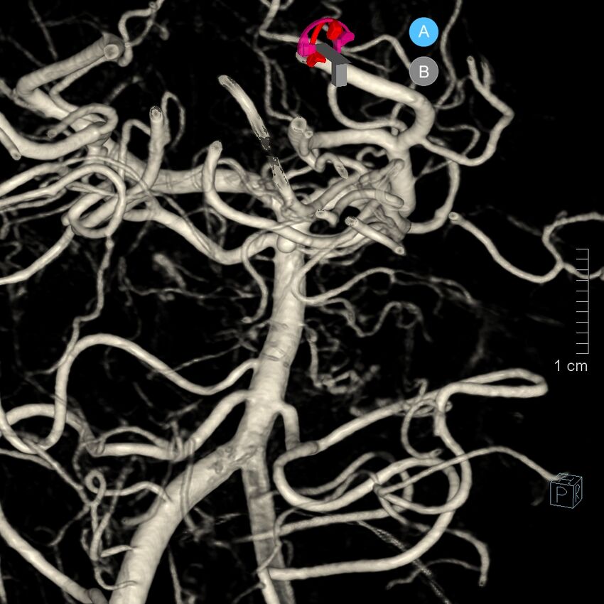 Basilar artery perforator aneurysm (Radiopaedia 82455-97734 3D view left VA 82).jpg