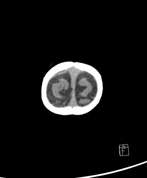 File:Benign enlargement of subarachnoid spaces in infancy (BESS) (Radiopaedia 87459-103795 Axial non-contrast 4).jpg
