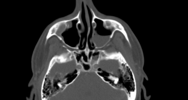 File:Benign mixed salivary tumor of the parotid gland (Radiopaedia 35261-36792 Axial bone window 6).jpg