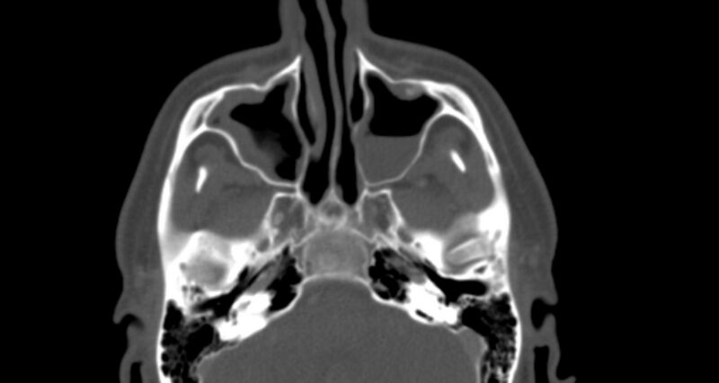 File:Benign mixed salivary tumor of the parotid gland (Radiopaedia 35261-36792 Axial bone window 8).jpg