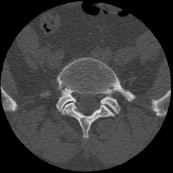 File:Bertolotti syndrome (Radiopaedia 24864-25128 Axial bone window 2).jpg