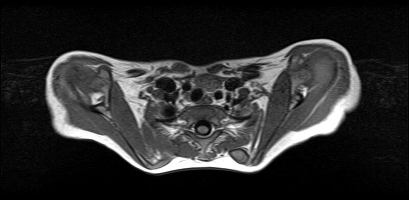 File:Bilateral Sprengel deformity with Klippel-Feil syndrome (Radiopaedia 66395-75650 Axial T1 20).jpg