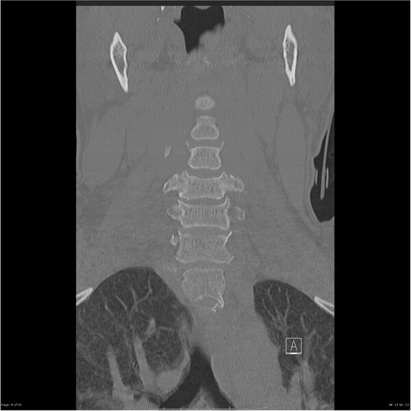 File:Bilateral cervical ribs (Radiopaedia 25868-26017 Coronal bone window 8).jpg