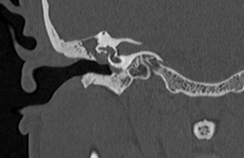 File:Bilateral cholesteatoma (Radiopaedia 54898-61172 Coronal bone window 37).jpg