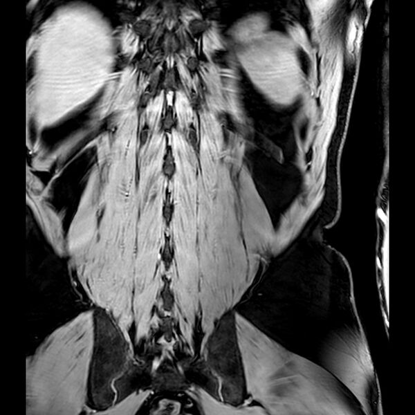 File:Bilateral conjoined nerve roots at different levels (Radiopaedia 73312-84063 B 44).jpg