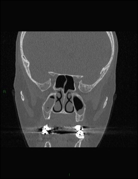 File:Bilateral frontal mucoceles (Radiopaedia 82352-96454 Coronal 186).jpg