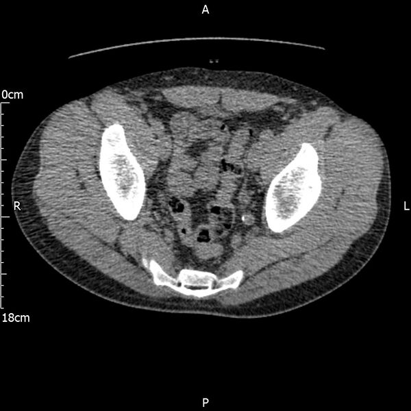 File:Bilateral medullary nephrocalcinosis with ureteric calculi (Radiopaedia 71269-81569 Axial non-contrast 114).jpg