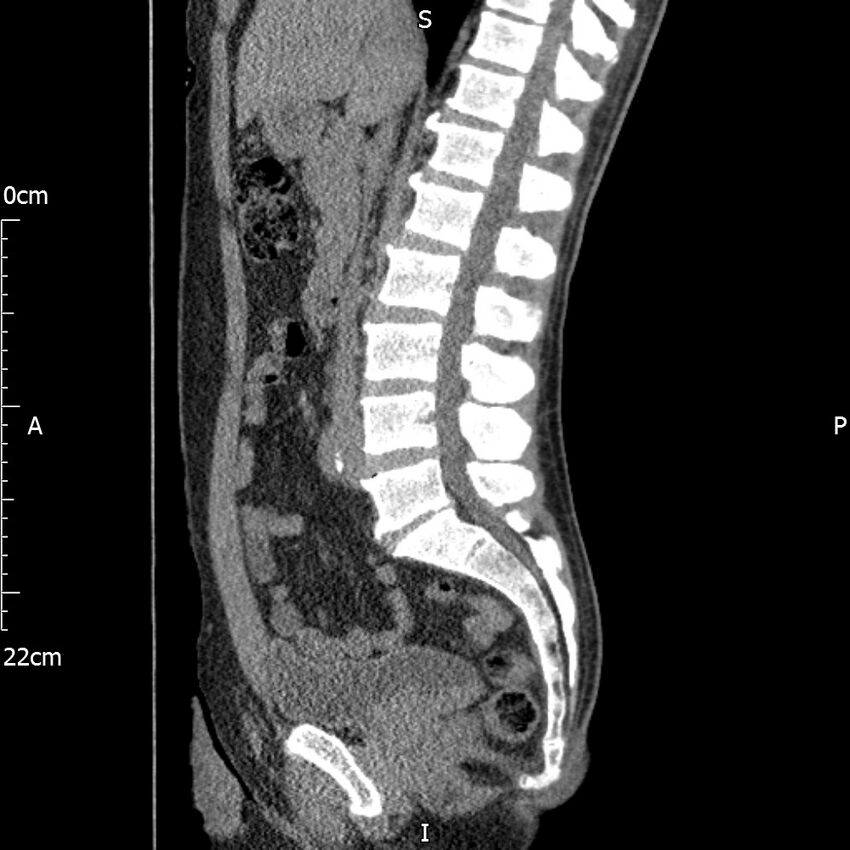 Bilateral medullary nephrocalcinosis with ureteric calculi (Radiopaedia 71269-81569 C 63).jpg