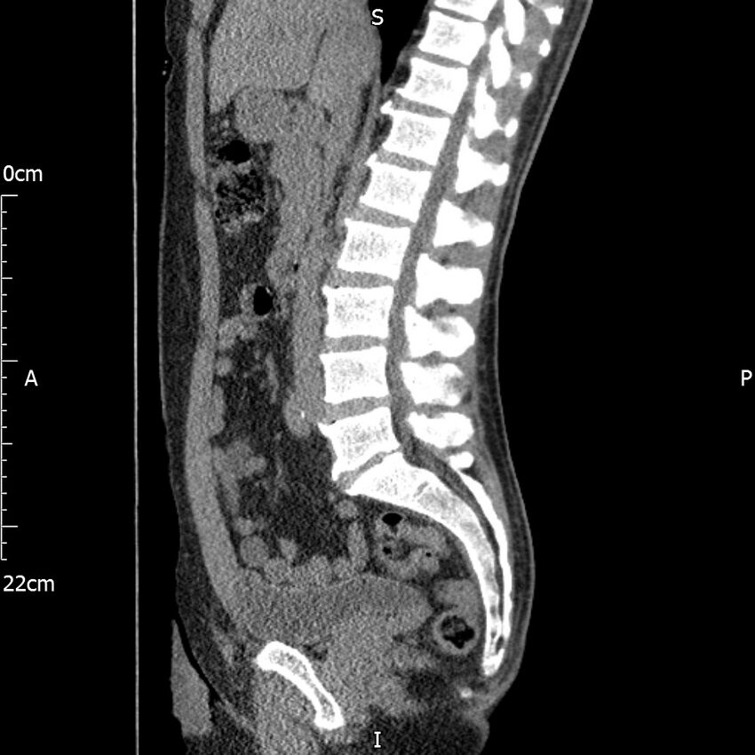 Bilateral medullary nephrocalcinosis with ureteric calculi (Radiopaedia 71269-81569 C 64).jpg