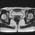 Bilateral ovarian endometriomas (Radiopaedia 87085-103347 Axial T2 16).jpg