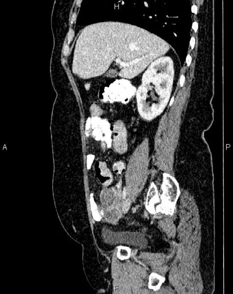 File:Bilateral ovarian serous cystadenocarcinoma (Radiopaedia 86062-101989 E 25).jpg