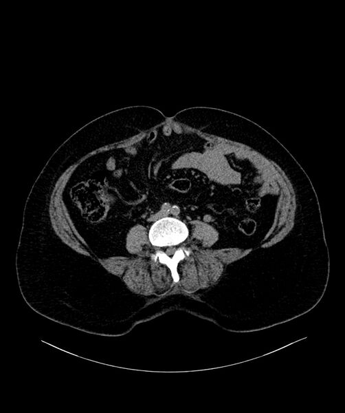 File:Bilateral sporadic synchronous clear cell renal cell carcinoma (Radiopaedia 85035-100572 Axial non-contrast 44).jpg