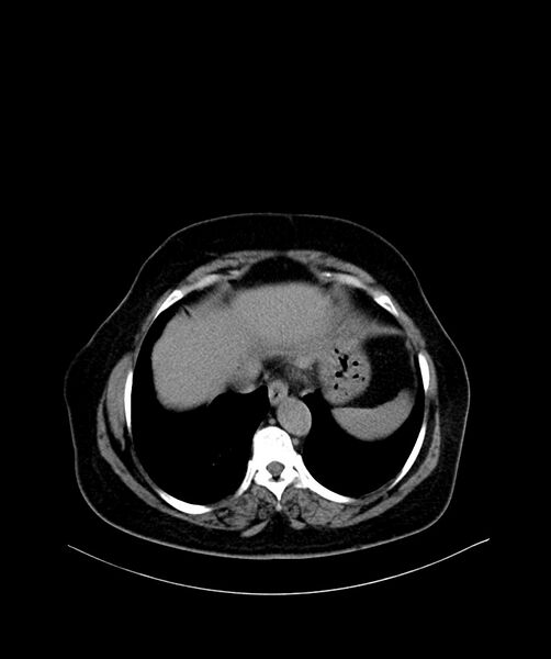 File:Bilateral sporadic synchronous clear cell renal cell carcinoma (Radiopaedia 85035-100572 Axial non-contrast 5).jpg