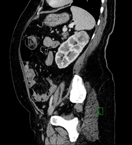 File:Bilateral sporadic synchronous clear cell renal cell carcinoma (Radiopaedia 85035-100575 G 32).jpg