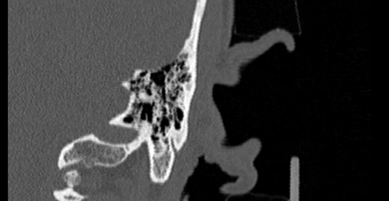 File:Bilateral temporal bone fractures (Radiopaedia 29482-29970 B 84).jpg