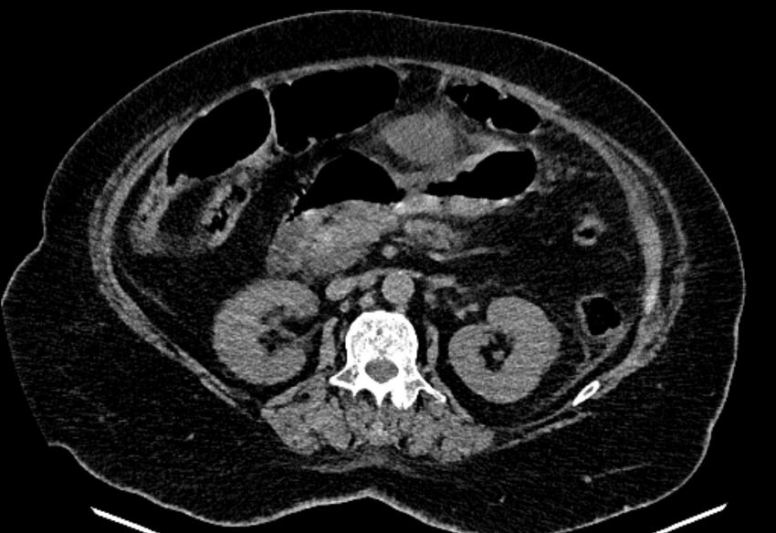 Biliary pancreatitis (Radiopaedia 72289-82823 Axial non-contrast 114).jpg