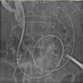Biliary stenting - lower CBD cholangiocarcinoma (Radiopaedia 10811-11255 H 1).jpg