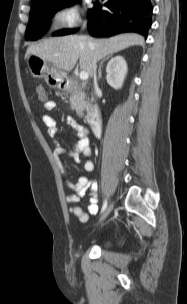 File:Bleeding duodenal ulcer and adenomyomatosis of gallbladder (Radiopaedia 61834-69861 C 40).jpg