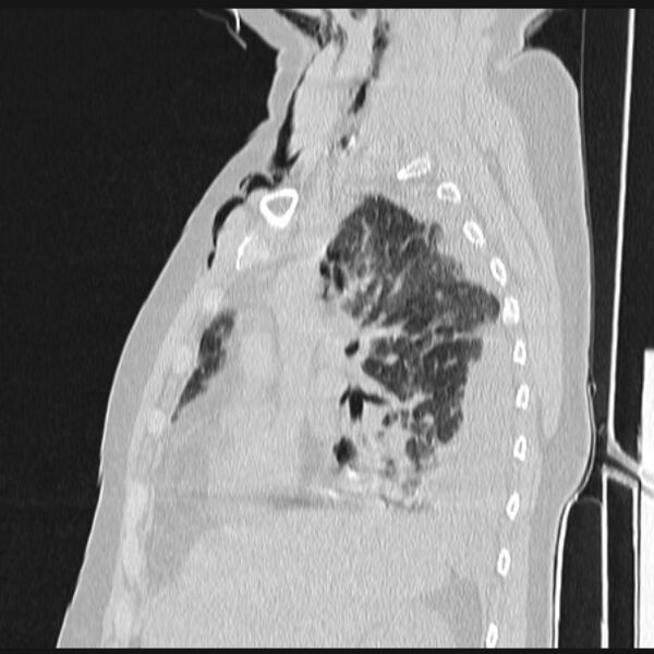 File:Boerhaave syndrome (Radiopaedia 45644-49799 Sagittal lung window 28).jpg