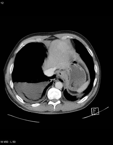 File:Boerhaave syndrome with tension pneumothorax (Radiopaedia 56794-63603 A 6).jpg