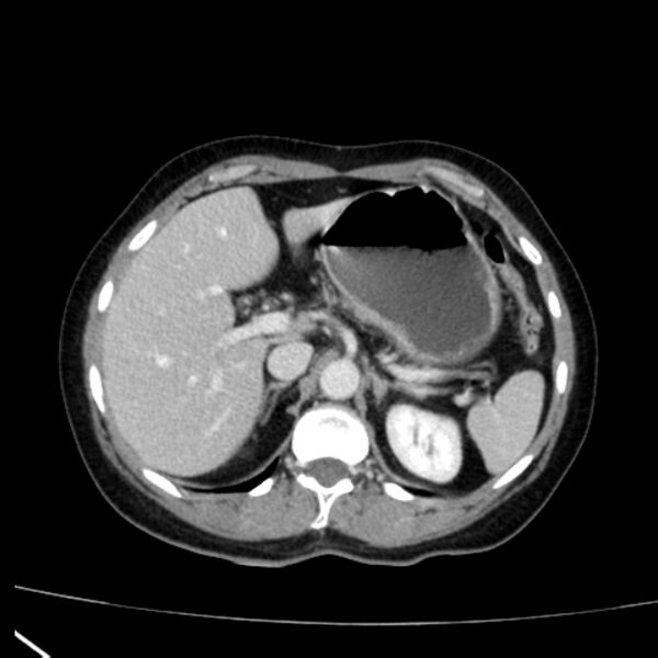 File:Bosniak renal cyst - type I (Radiopaedia 27479-27675 C 21).jpg