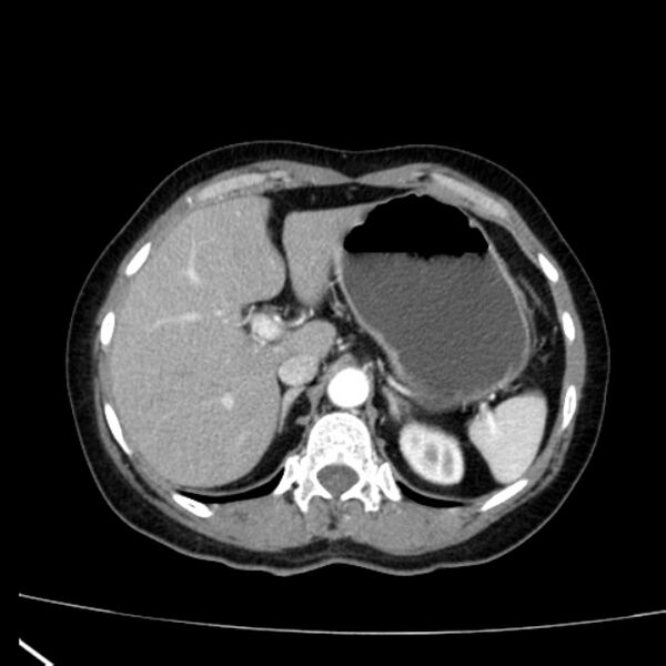 File:Bosniak renal cyst - type I (Radiopaedia 27479-27675 renal cortical phase 17).jpg