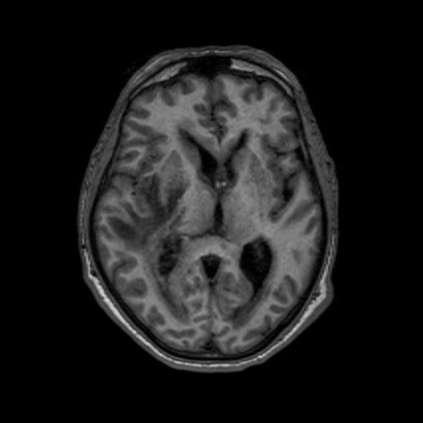 File:Brain abscess complicated by intraventricular rupture and ventriculitis (Radiopaedia 82434-96577 Axial T1 34).jpg
