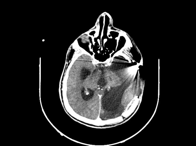 File:Brain injury by firearm projectile (Radiopaedia 82068-96088 B 117).jpg