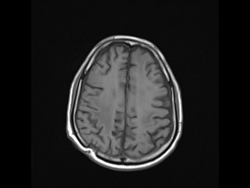 File:Brain metastases from renal cell carcinoma (Radiopaedia 42222-45297 Axial T1 19).jpg