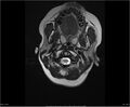 Brainstem glioma (Radiopaedia 21819-21775 Axial T2 1).jpg