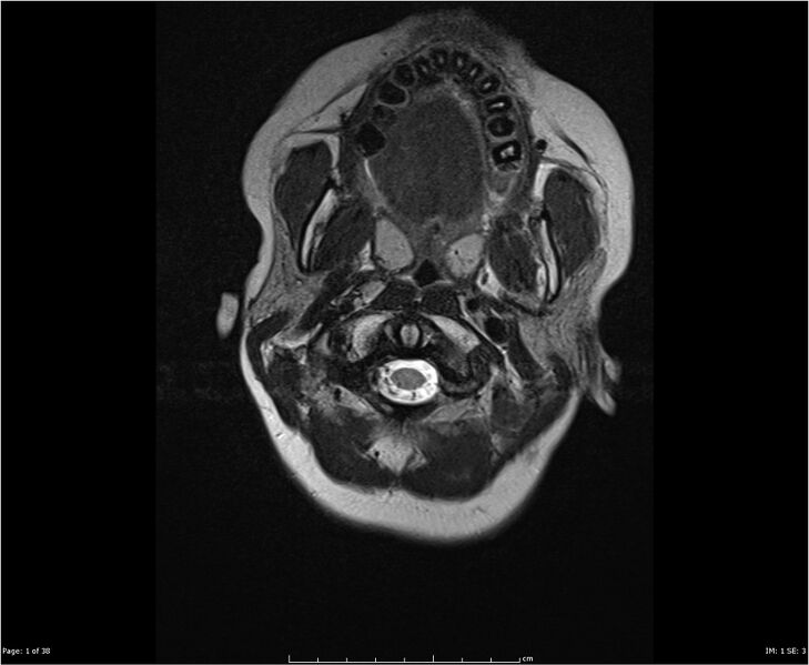 File:Brainstem glioma (Radiopaedia 21819-21775 Axial T2 1).jpg