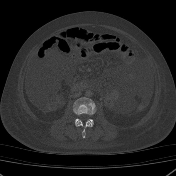 File:Breast cancer metastases - hepatic and skeletal (Radiopaedia 34201-35461 Axial bone window 64).jpg
