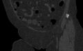 Breast carcinoma with pathological hip fracture (Radiopaedia 60314-67993 Coronal bone window 46).jpg